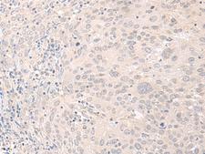FOXRED2 Antibody - Immunohistochemistry of paraffin-embedded Human cervical cancer tissue  using FOXRED2 Polyclonal Antibody at dilution of 1:35(×200)