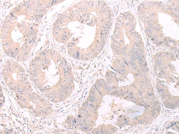 FOXRED2 Antibody - Immunohistochemistry of paraffin-embedded Human colorectal cancer tissue  using FOXRED2 Polyclonal Antibody at dilution of 1:35(×200)