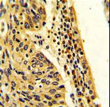 FPGS Antibody - Formalin-fixed and paraffin-embedded human lung carcinoma with FPGS Antibody , which was peroxidase-conjugated to the secondary antibody, followed by DAB staining. This data demonstrates the use of this antibody for immunohistochemistry; clinical relevance has not been evaluated.