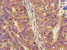 FPR3 / FPRL2 Antibody - Immunohistochemistry image of paraffin-embedded human colon cancer at a dilution of 1:100