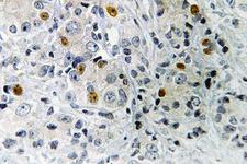 FRA-1 / FOSL1 Antibody - Immunohistochemistry (IHC) analysis of Fra-1 (D134) pAb in paraffin-embedded human prostate cancer tissue.