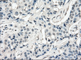 FRA-1 / FOSL1 Antibody - IHC of paraffin-embedded Adenocarcinoma of breast tissue using anti-FOSL1 mouse monoclonal antibody. (Dilution 1:50).