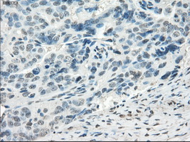 FRA-1 / FOSL1 Antibody - IHC of paraffin-embedded Adenocarcinoma of ovary tissue using anti-FOSL1 mouse monoclonal antibody. (Dilution 1:50).