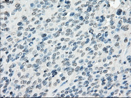 FRA-1 / FOSL1 Antibody - IHC of paraffin-embedded Carcinoma of bladder tissue using anti-FOSL1 mouse monoclonal antibody. (Dilution 1:50).