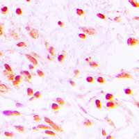 FRA-1 / FOSL1 Antibody - Immunohistochemical analysis of FOSL1 staining in human lung cancer formalin fixed paraffin embedded tissue section. The section was pre-treated using heat mediated antigen retrieval with sodium citrate buffer (pH 6.0). The section was then incubated with the antibody at room temperature and detected using an HRP conjugated compact polymer system. DAB was used as the chromogen. The section was then counterstained with hematoxylin and mounted with DPX.