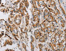 Fragilis / IFITM3 Antibody - Immunohistochemistry of paraffin-embedded Human breast cancer using IFITM3 Polyclonal Antibody at dilution of 1:25.