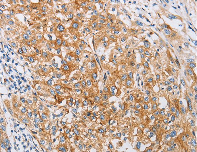 Fragilis / IFITM3 Antibody - Immunohistochemistry of paraffin-embedded Human esophagus cancer using IFITM3 Polyclonal Antibody at dilution of 1:25.