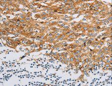 Fragilis / IFITM3 Antibody - Immunohistochemistry of paraffin-embedded Human esophagus cancer using IFITM3 Polyclonal Antibody at dilution of 1:20.