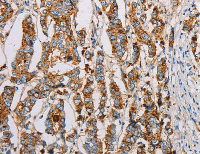 Fragilis / IFITM3 Antibody - Immunohistochemistry of paraffin-embedded Human breast cancer using IFITM3 Polyclonal Antibody at dilution of 1:20.