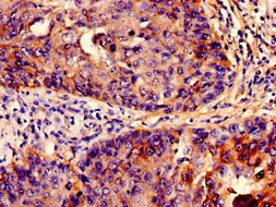 Fragilis / IFITM3 Antibody - Immunohistochemistry analysis of human cervical cancer at a dilution of 1:100
