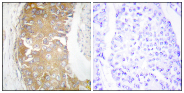 FRK Antibody - Immunohistochemistry analysis of paraffin-embedded human breast carcinoma tissue, using FRK Antibody. The picture on the right is blocked with the synthesized peptide.