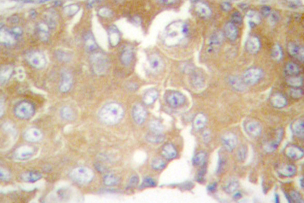 FRK Antibody - IHC of Rak (N103) pAb in paraffin-embedded human breast carcinoma tissue.