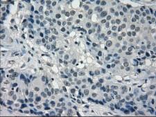 FRK Antibody - IHC of paraffin-embedded Adenocarcinoma of breast tissue using anti-FRK mouse monoclonal antibody. (Dilution 1:50).