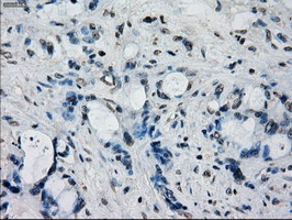FRK Antibody - IHC of paraffin-embedded Adenocarcinoma of colon tissue using anti-FRK mouse monoclonal antibody. (Dilution 1:50).