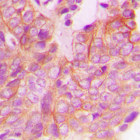 FRK Antibody - Immunohistochemical analysis of FRK staining in human breast cancer formalin fixed paraffin embedded tissue section. The section was pre-treated using heat mediated antigen retrieval with sodium citrate buffer (pH 6.0). The section was then incubated with the antibody at room temperature and detected using an HRP conjugated compact polymer system. DAB was used as the chromogen. The section was then counterstained with hematoxylin and mounted with DPX.
