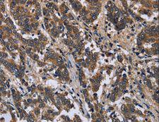 FRK Antibody - Immunohistochemistry of paraffin-embedded Human liver cancer using FRK Polyclonal Antibody at dilution of 1:50.