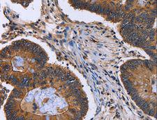 FRK Antibody - Immunohistochemistry of paraffin-embedded Human colon cancer using FRK Polyclonal Antibody at dilution of 1:40.