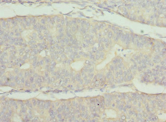 FRK Antibody - Immunohistochemistry of paraffin-embedded human endometrial cancer at dilution 1:100
