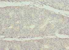 FRK Antibody - Immunohistochemistry of paraffin-embedded human endometrial cancer at dilution 1:100