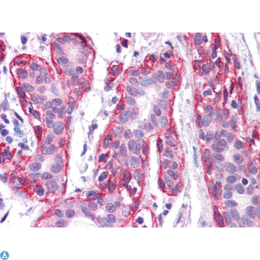 FRK Antibody - Immunohistochemistry (IHC) analysis of paraffin-embedded Human Breast tissues with AEC staining using Rak Monoclonal Antibody.