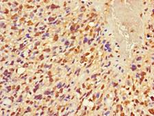FRMD5 Antibody - Immunohistochemistry of paraffin-embedded human glioma at dilution 1:100