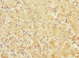 FRMD6 Antibody - Immunohistochemistry of paraffin-embedded human liver cancer at dilution 1:100