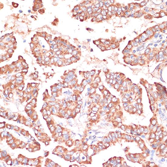 FRMD6 Antibody - Immunohistochemistry of paraffin-embedded Human thyroid cancer using FRMD6 Polyclonal Antibody at dilution of 1:100 (40x lens).