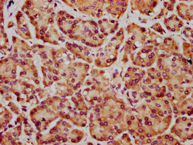 FRMD7 Antibody - Immunohistochemistry Dilution at 1:400 and staining in paraffin-embedded human pancreatic cancer performed on a Leica BondTM system. After dewaxing and hydration, antigen retrieval was mediated by high pressure in a citrate buffer (pH 6.0). Section was blocked with 10% normal Goat serum 30min at RT. Then primary antibody (1% BSA) was incubated at 4°C overnight. The primary is detected by a biotinylated Secondary antibody and visualized using an HRP conjugated SP system.
