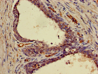 FRS2 Antibody - Immunohistochemistry of paraffin-embedded human prostate cancer using FRS2 Antibody at dilution of 1:100