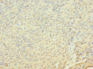 FRS3 Antibody - Immunohistochemistry of paraffin-embedded human cervical cancer using FRS3 Antibody at dilution of 1:100