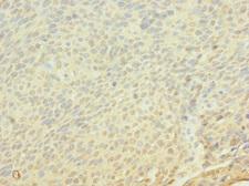 FRS3 Antibody - Immunohistochemistry of paraffin-embedded human cervical cancer using FRS3 Antibody at dilution of 1:100