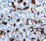 FSCN / Fascin Antibody - IHC of Fascin on FFPE Hodgkin's Lymphoma tissue. This image was taken for the unmodified form of this product. Other forms have not been tested.