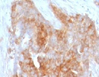 FSCN1 / Fascin Antibody - IHC testing of FFPE human ovarian carcinoma with Fascin antibody (clone FAN55-1).  This image was taken for the unmodified form of this product. Other forms have not been tested.