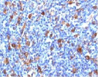 FSCN1 / Fascin Antibody - IHC testing of FFPE Hodgkin's lymphoma with Fascin antibody (clone FAN55-1).  This image was taken for the unmodified form of this product. Other forms have not been tested.