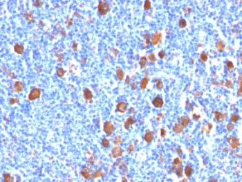 FSCN1 / Fascin Antibody - Formalin-fixed, paraffin-embedded human Hodgkin's lymphoma stained with Fascin antibody (FSCN1/416).  This image was taken for the unmodified form of this product. Other forms have not been tested.