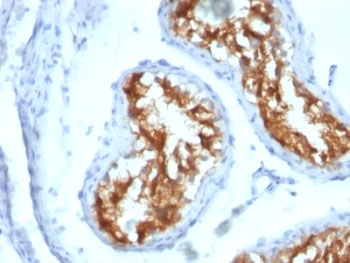 FSCN1 / Fascin Antibody - Formalin-fixed, paraffin-embedded human testicular carcinoma stained with Fascin antibody (FSCN1/417).  This image was taken for the unmodified form of this product. Other forms have not been tested.