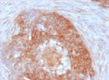FSCN1 / Fascin Antibody - Formalin-fixed, paraffin-embedded human ovarian carcinoma stained with Fascin antibody (FSCN1/417).  This image was taken for the unmodified form of this product. Other forms have not been tested.