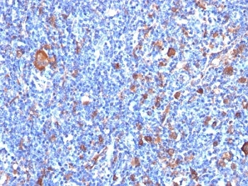 FSCN1 / Fascin Antibody - Formalin-fixed, paraffin-embedded human Hodgkin's lymphoma stained with Fascin antibody (FSCN1/417).  This image was taken for the unmodified form of this product. Other forms have not been tested.