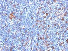 FSCN1 / Fascin Antibody - Formalin-fixed, paraffin-embedded human Hodgkin's lymphoma stained with Fascin antibody (FSCN1/417).  This image was taken for the unmodified form of this product. Other forms have not been tested.