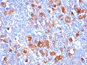FSCN1 / Fascin Antibody - Formalin-fixed, paraffin-embedded human Hodgkin's lymphoma stained with Fascin antibody (FSCN1/418).  This image was taken for the unmodified form of this product. Other forms have not been tested.