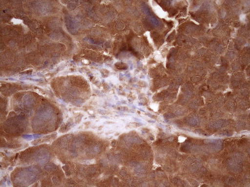 FSCN1 / Fascin Antibody - Immunohistochemical staining of paraffin-embedded Adenocarcinoma of Human ovary tissue using anti-FSCN1 mouse monoclonal antibody. (Heat-induced epitope retrieval by Tris-EDTA, pH8.0)(1:150)