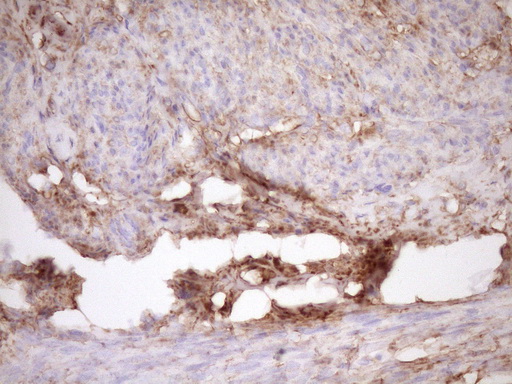 FSCN1 / Fascin Antibody - Immunohistochemical staining of paraffin-embedded Human thyroid tissue within the normal limits using anti-FSCN1 mouse monoclonal antibody. (Heat-induced epitope retrieval by Tris-EDTA, pH8.0)(1:150)