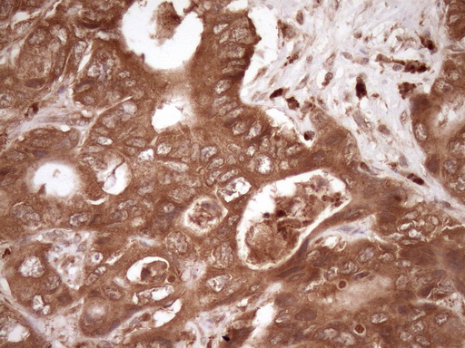 FSCN1 / Fascin Antibody - Immunohistochemical staining of paraffin-embedded Adenocarcinoma of Human colon tissue using anti-FSCN1 mouse monoclonal antibody. (Heat-induced epitope retrieval by Tris-EDTA, pH8.0)(1:150)