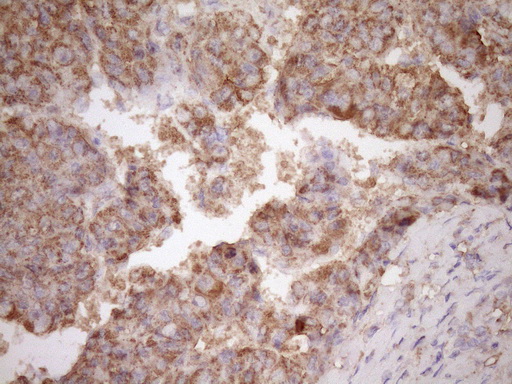 FSCN1 / Fascin Antibody - Immunohistochemical staining of paraffin-embedded Carcinoma of Human liver tissue using anti-FSCN1 mouse monoclonal antibody. (Heat-induced epitope retrieval by Tris-EDTA, pH8.0)(1:150)