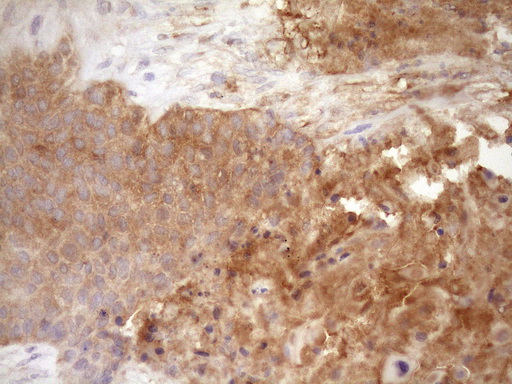 FSCN1 / Fascin Antibody - IHC of paraffin-embedded Carcinoma of Human lung tissue using anti-FSCN1 mouse monoclonal antibody. (Heat-induced epitope retrieval by Tris-EDTA, pH8.0)(1:150).