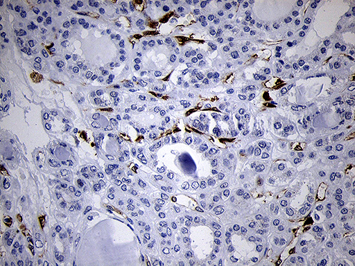 FSCN1 / Fascin Antibody - Immunohistochemical staining of paraffin-embedded Carcinoma of Human thyroid tissue using anti-FSCN1 mouse monoclonal antibody. (Heat-induced epitope retrieval by 1mM EDTA in 10mM Tris buffer. (pH8.5) at 120°C for 3 min. (1:500)