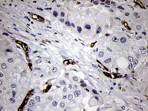 FSCN1 / Fascin Antibody - Immunohistochemical staining of paraffin-embedded Adenocarcinoma of Human breast tissue tissue using anti-FSCN1 mouse monoclonal antibody. (Heat-induced epitope retrieval by 1mM EDTA in 10mM Tris buffer. (pH8.5) at 120°C for 3 min. (1:500)