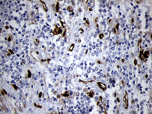 FSCN1 / Fascin Antibody - Immunohistochemical staining of paraffin-embedded Human lymphoma tissue using anti-FSCN1 mouse monoclonal antibody. (Heat-induced epitope retrieval by 1mM EDTA in 10mM Tris buffer. (pH8.5) at 120°C for 3 min. (1:500)