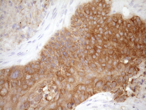 FSCN1 / Fascin Antibody - Immunohistochemical staining of paraffin-embedded Carcinoma of Human lung tissue using anti-FSCN1 mouse monoclonal antibody. (Heat-induced epitope retrieval by Tris-EDTA, pH8.0)(1:150)