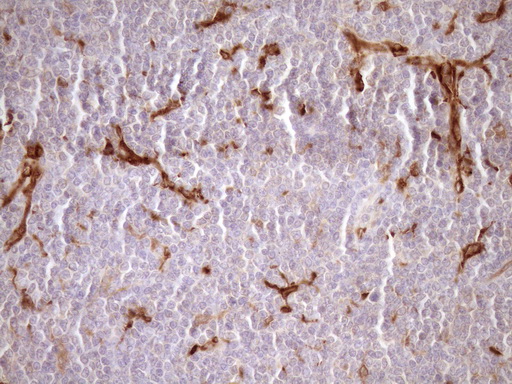 FSCN1 / Fascin Antibody - Immunohistochemical staining of paraffin-embedded Human lymphoma tissue using anti-FSCN1 mouse monoclonal antibody. (Heat-induced epitope retrieval by Tris-EDTA, pH8.0)(1:150)